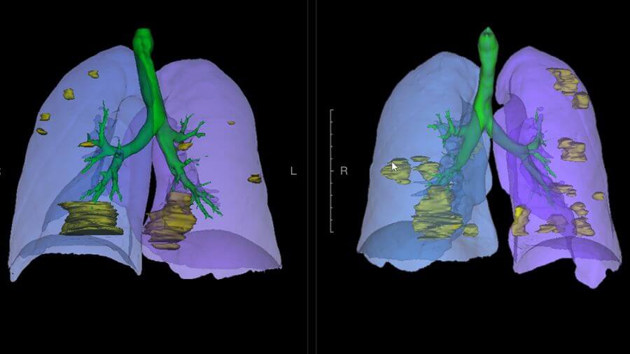Huawei-AI-system-COVID-19